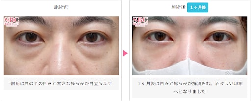裏ハムラ法の症例写真