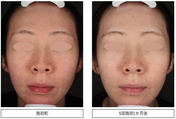 IPL光治療の症例写真