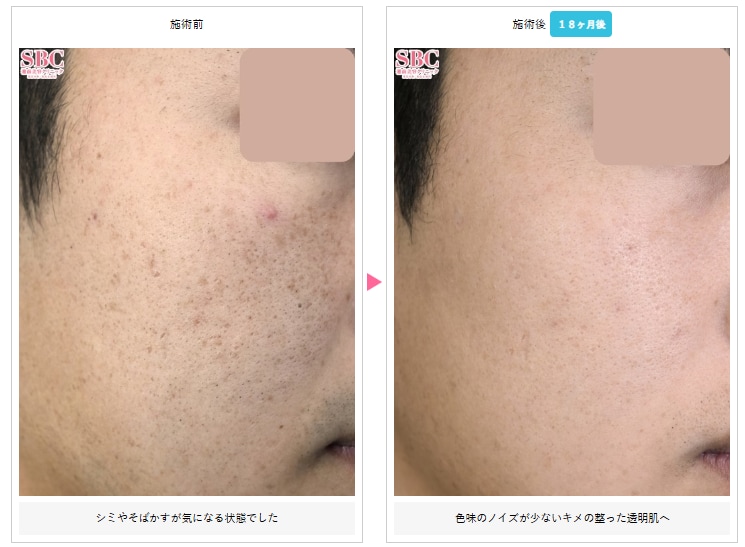 IPL光治療の症例写真