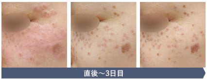 シミ取りレーザーのダウンタイム：直後～3日目