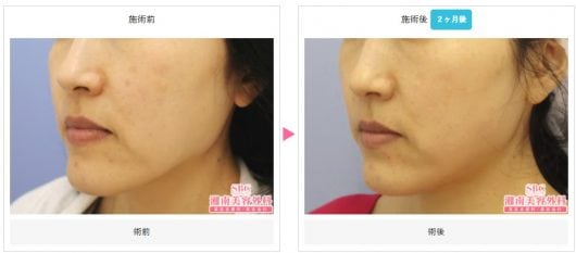 レーザートーニングによる肝斑治療の症例写真
