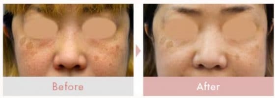 エレクトロポレーション（イオン導入）による肝斑・シミ改善の症例写真