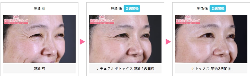 ボトックスの症例写真