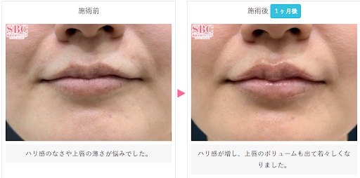 ヒアルロン酸の症例写真