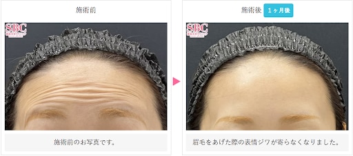 ボトックス(アラガン)の症例写真