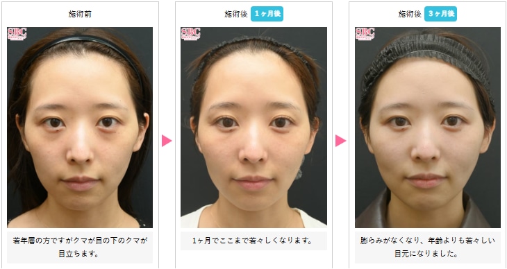 目の下の切らないクマ・たるみ（ふくらみ）取りの症例写真