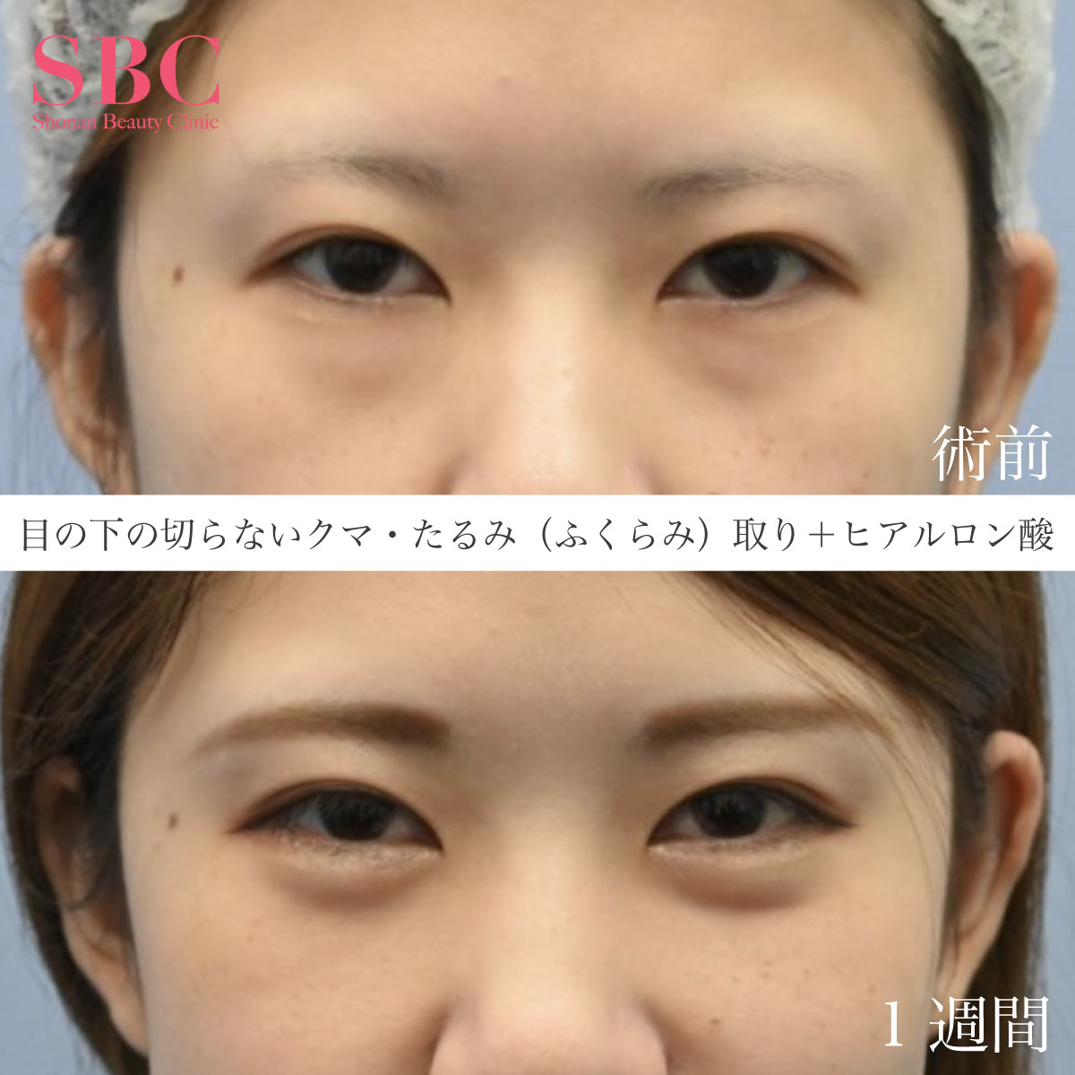 安心丁寧 Dr石井の切らないたるみ取り 若返りモニター募集 美容整形 美容外科の湘南美容クリニック 安心丁寧 Dr石井の切らないたるみ取り 若返りモニター募集 美容整形 美容外科の湘南美容クリニック