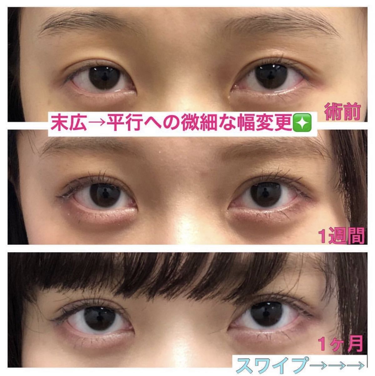 二重埋没法 2 14出張限定 インスタ 二重 二重整形モニター募集 美容整形 美容外科の湘南美容クリニック