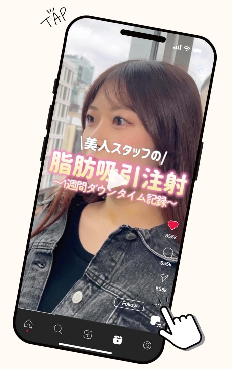 脂肪吸引のダウンタイム