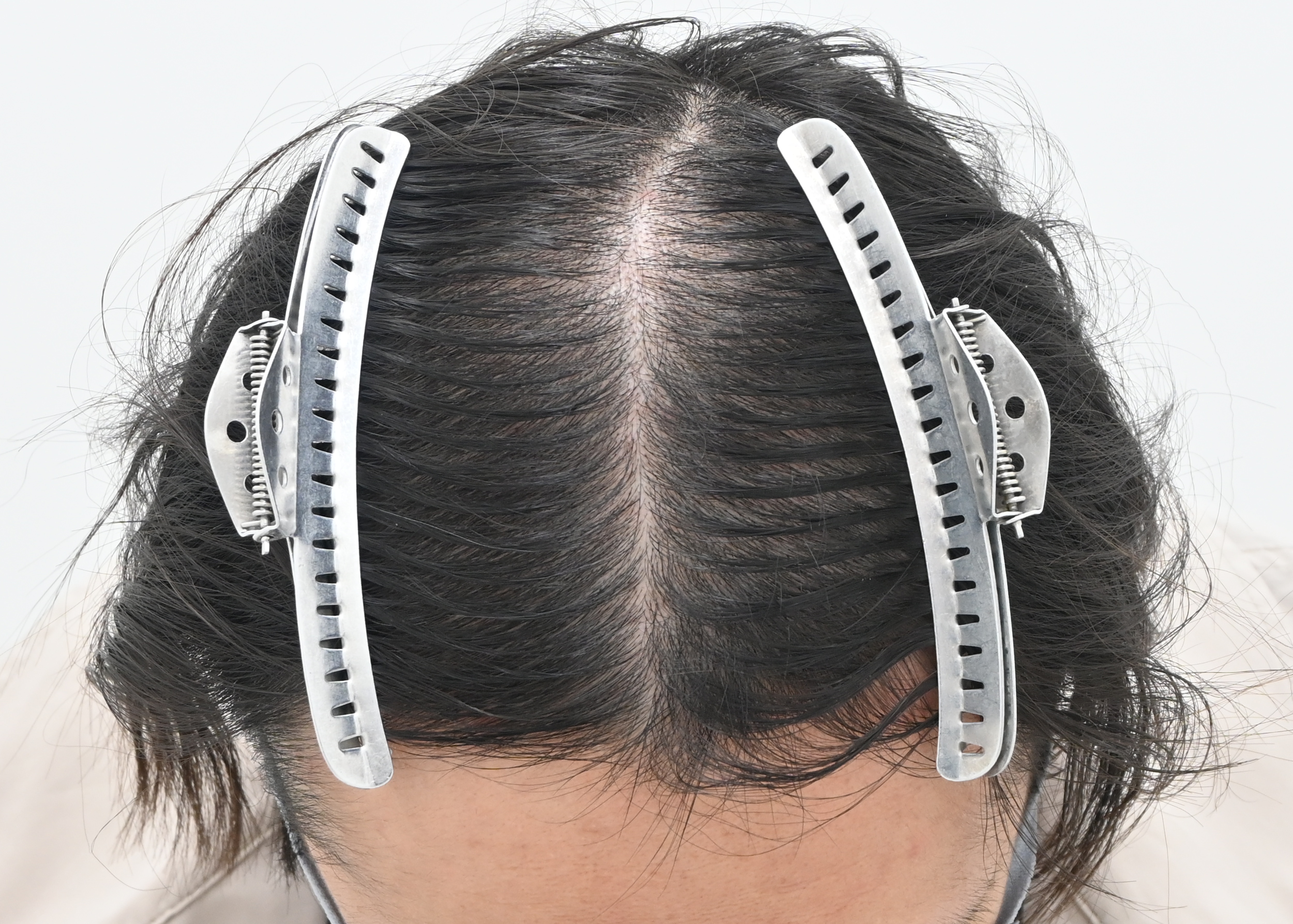 針を使わないメソセラピー『エレクトロポーションメソ』で髪の毛を太く