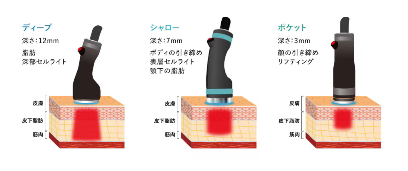 オンダハンドピース画像 