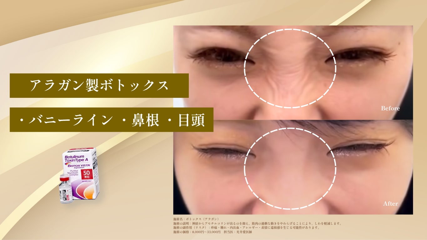 アラガン製ボトックス症例写真