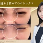 ボトックスサムネ画像