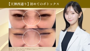 ボトックスサムネ画像