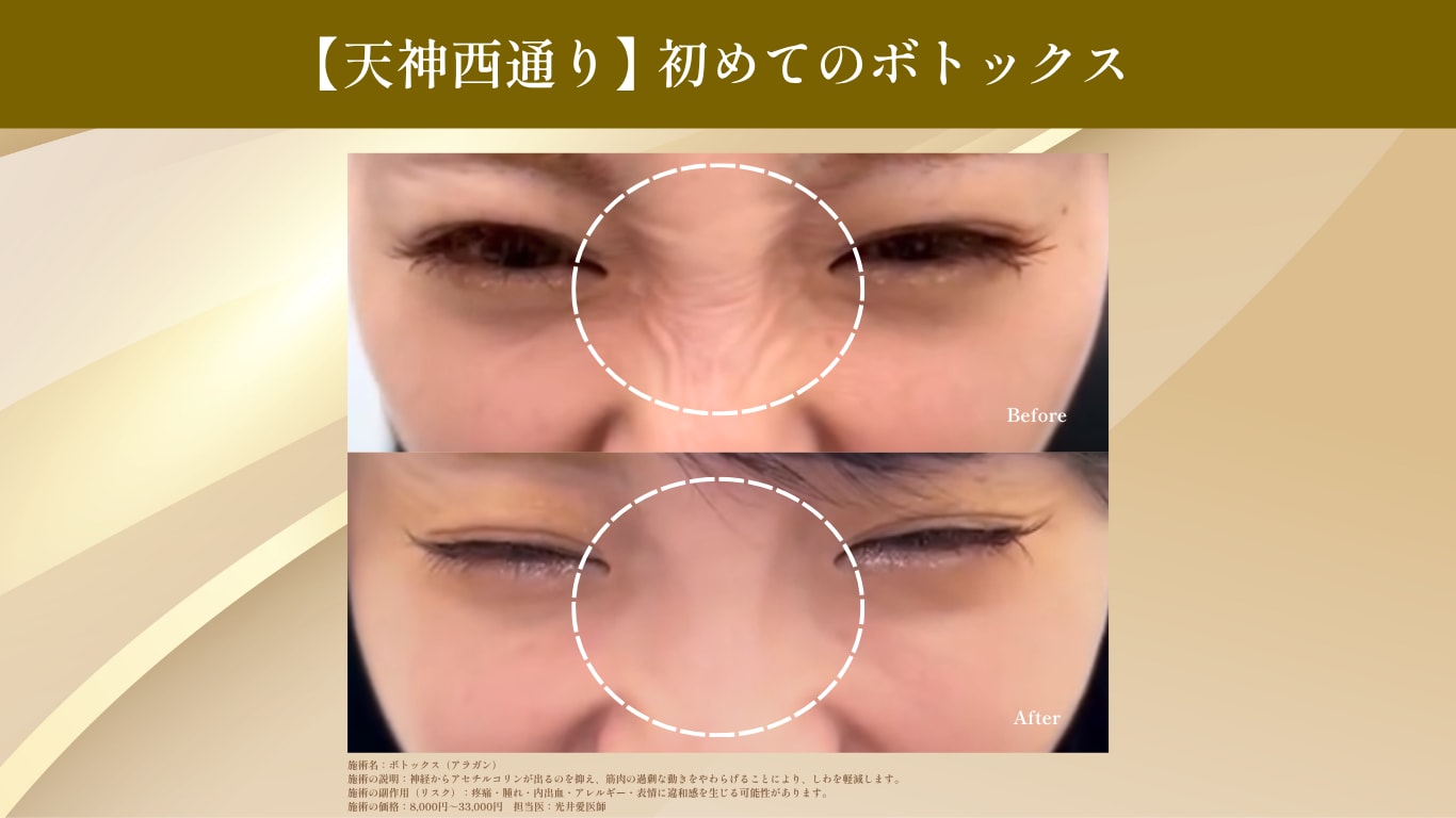 ボトックス画像