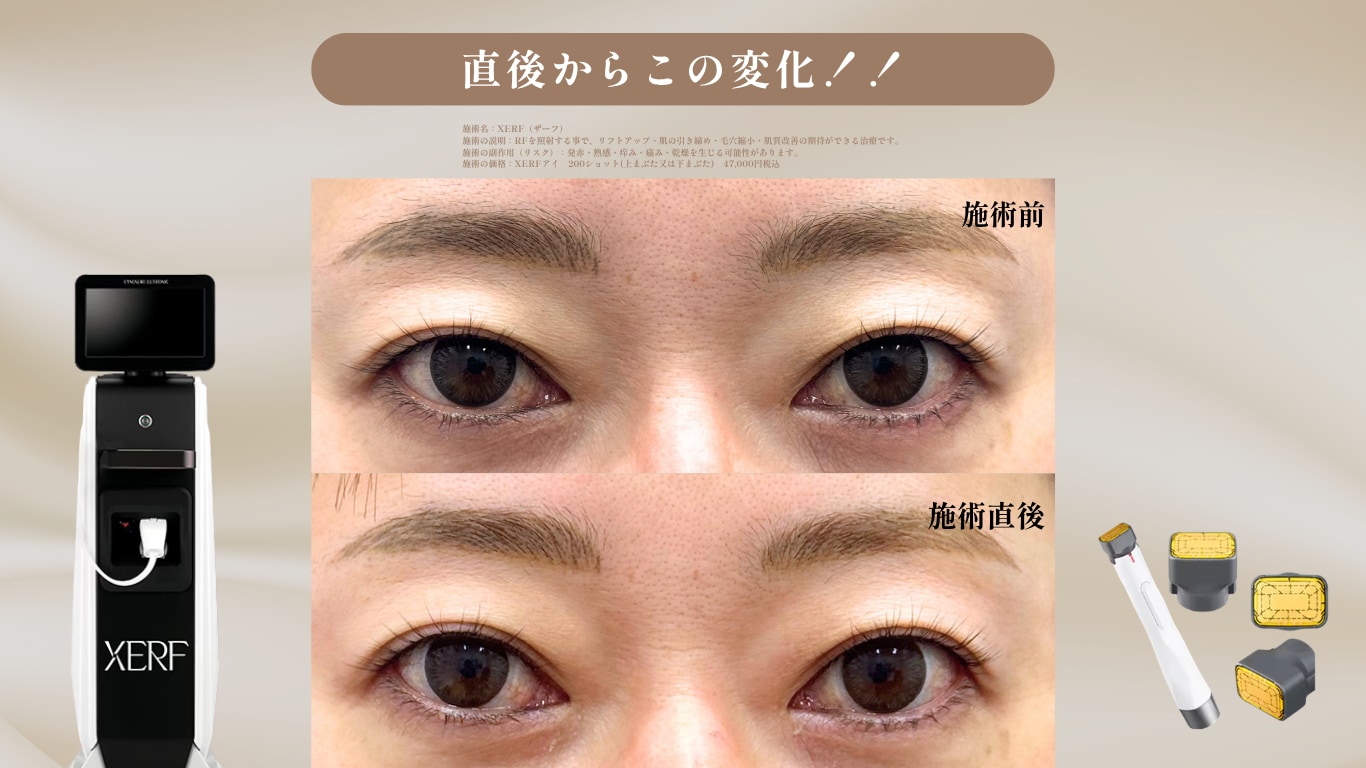 ザーフアイ症例写真