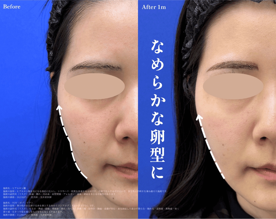 糸サテライト症例写真