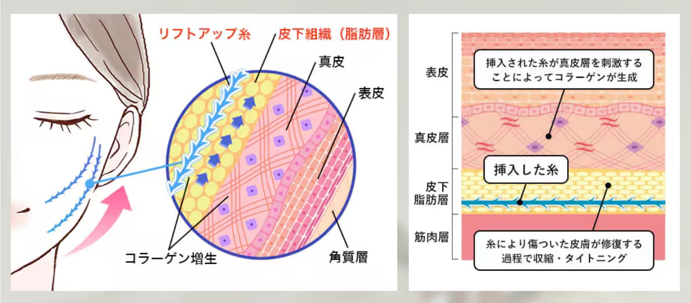 糸サテライトイラスト