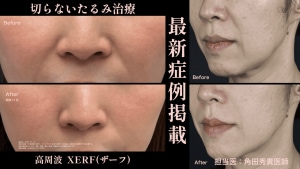 サテライトXERFサムネ