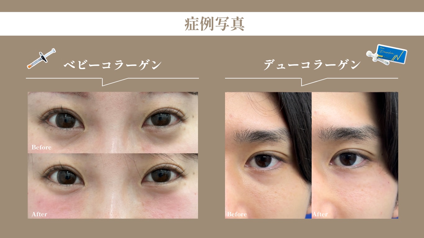 切らないクマ取り ベビーコラーゲン・デューコラーゲン症例写真｜湘南美容皮フ科 福岡天神院