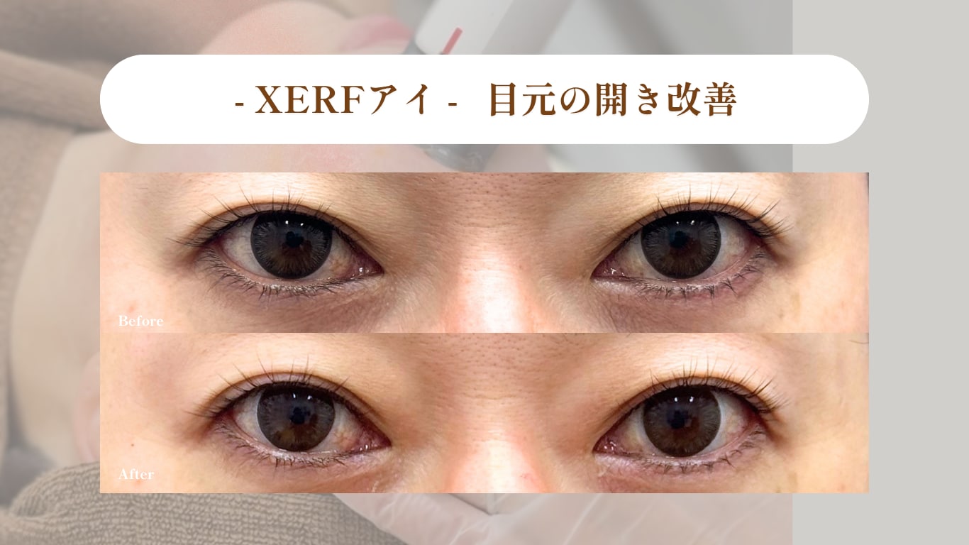 切らないクマ取り ザーフアイ（高周波RF）症例写真｜湘南美容皮フ科 福岡天神院