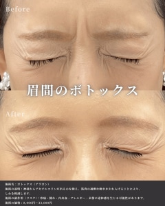 眉間ボトックス症例画像