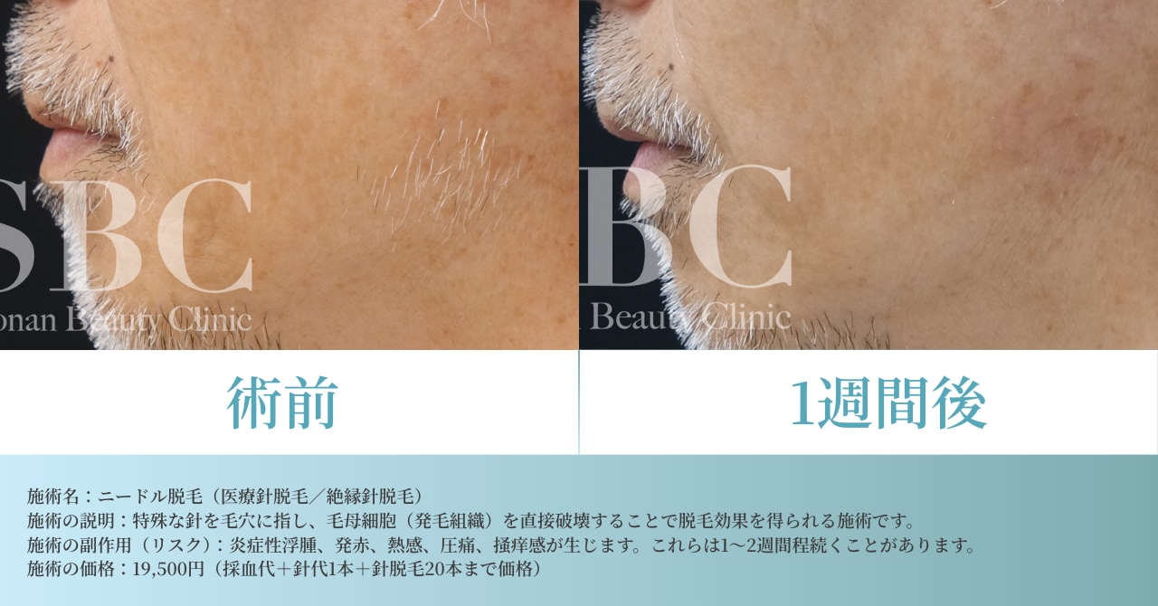 白髪の髭のニードル脱毛の術前と１週間後