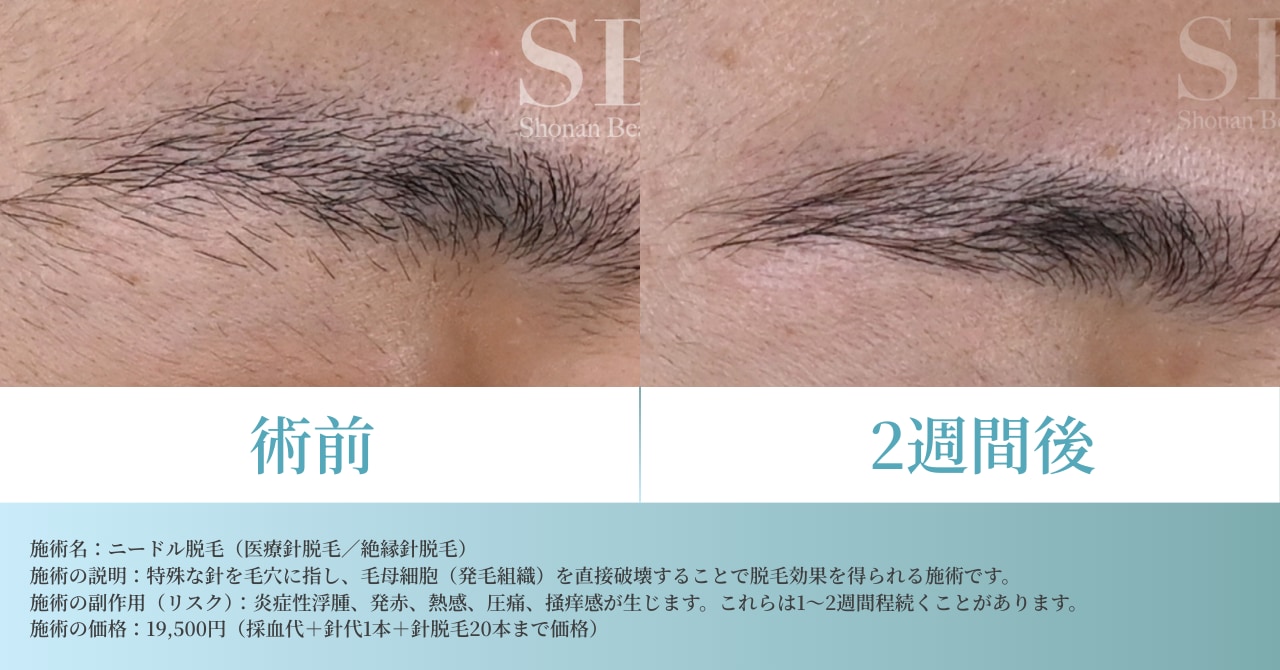 眉毛のニードル脱毛2週間後