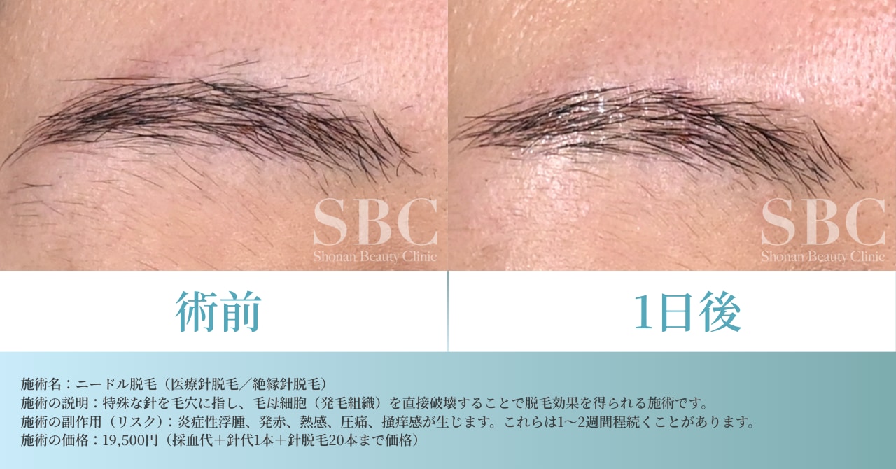 ニードル脱毛の術前と1日後の症例写真