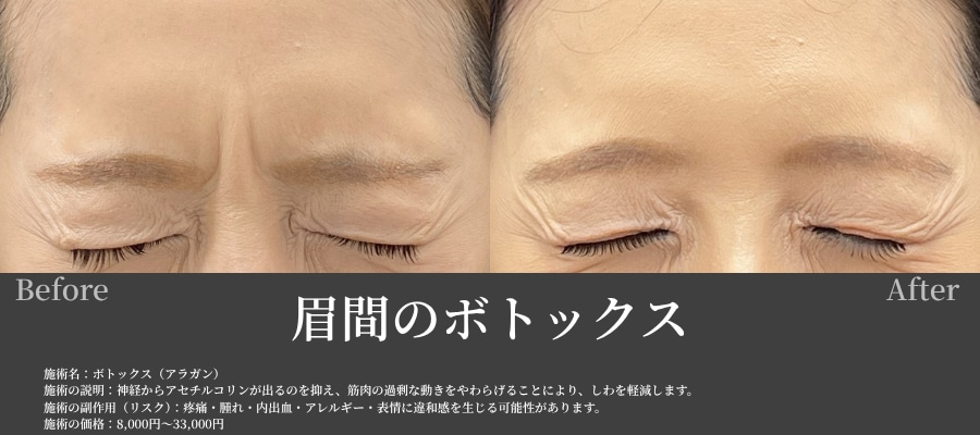 眉間のボトックス画像