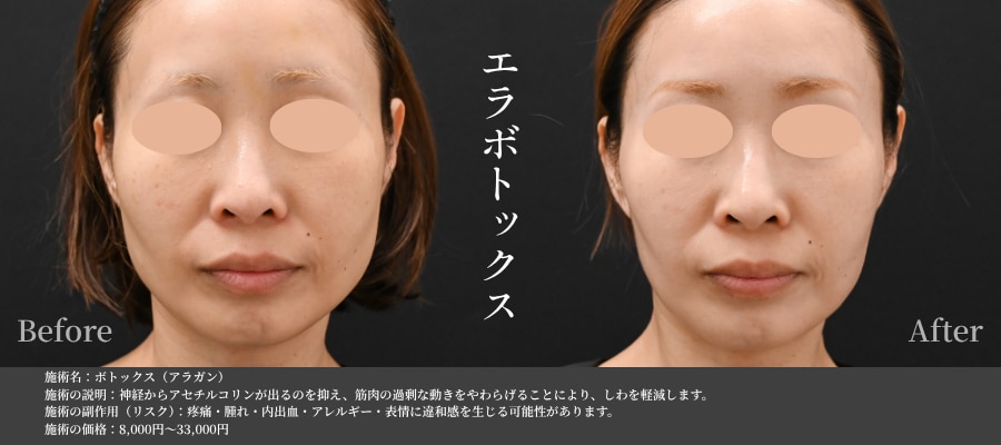 エラのボトックス画像
