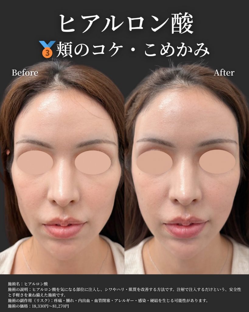 ヒアルロン酸症例