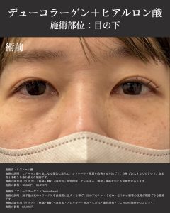 デューコラーゲンとヒアルロン酸の画像