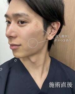 ジャルプロ注入直後画像