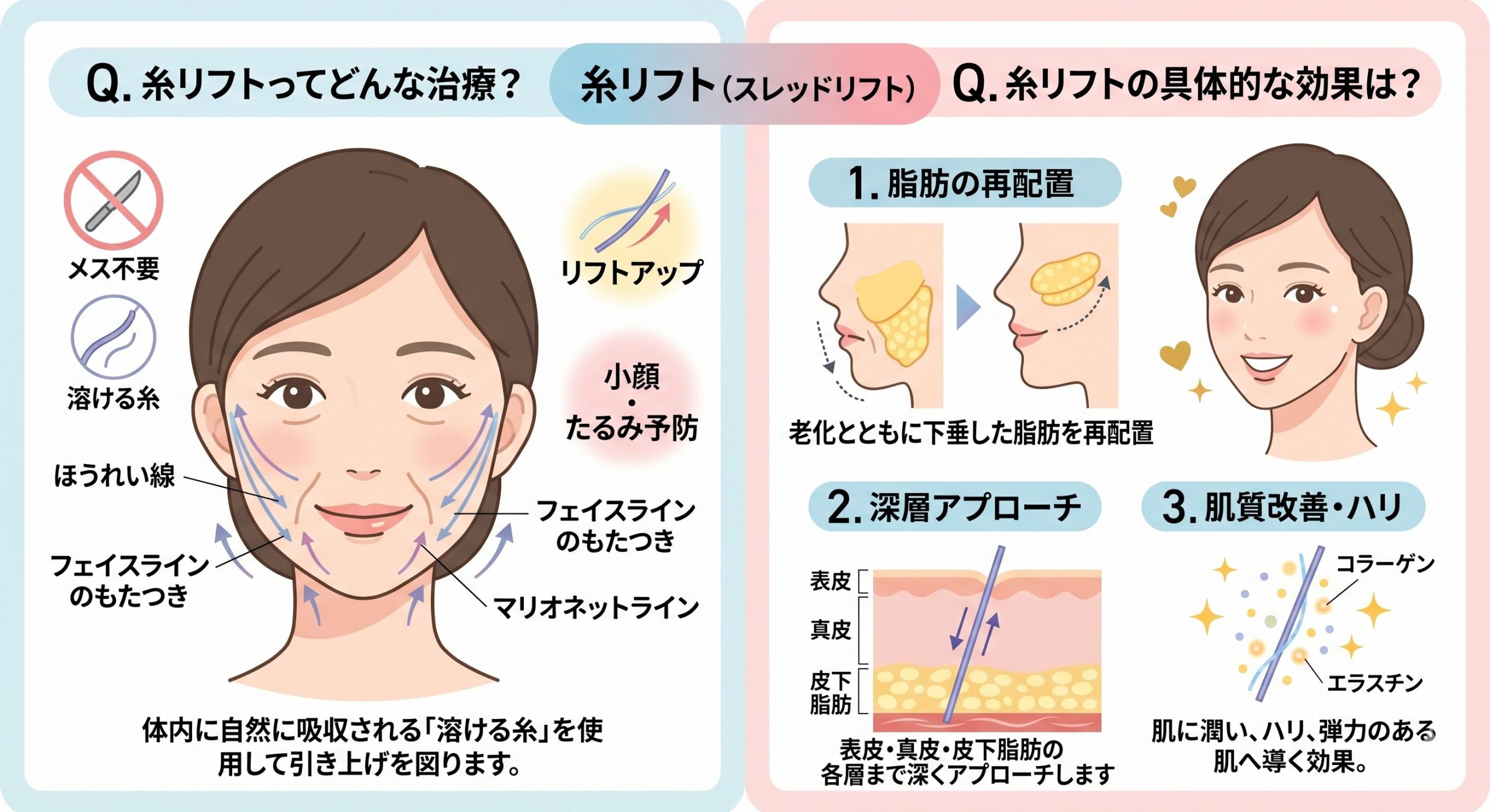 糸リフトよくある質問画像