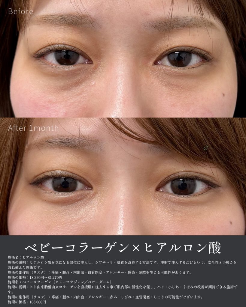 ベビコラクマ取り症例