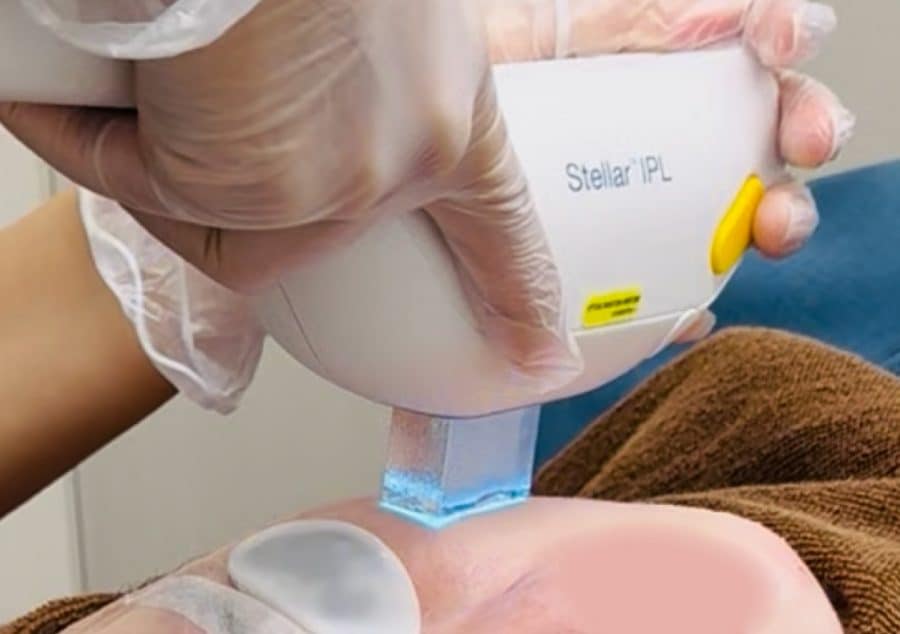 フォトジェネシスの特徴・ステラM22の施術風景