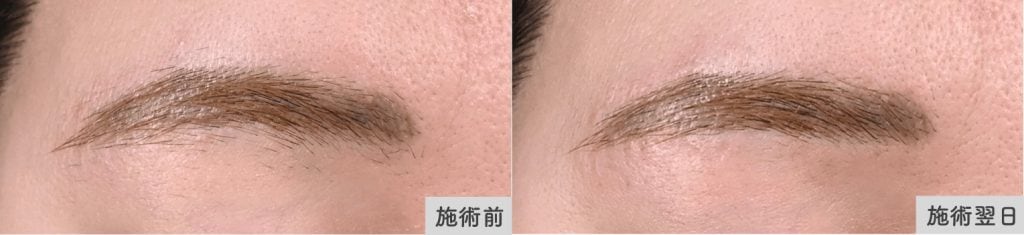 ニードル脱毛眉毛の症例写真