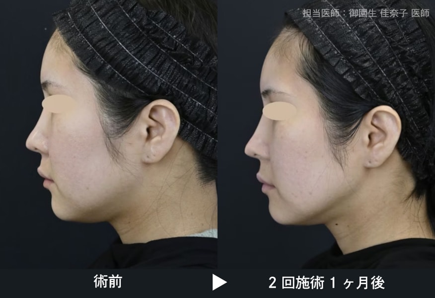 オンダリフト症例写真