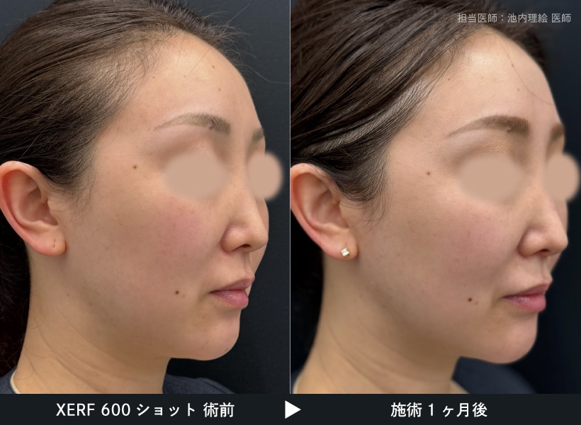 XERFザーフ症例600ショット