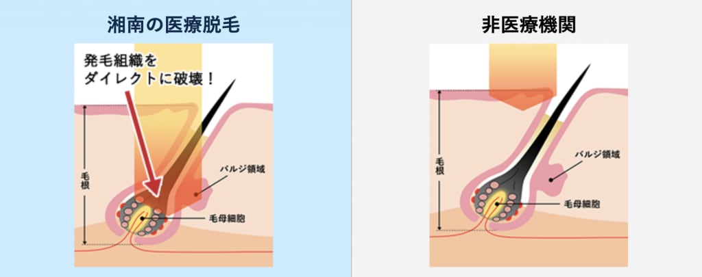 脱毛機械画像