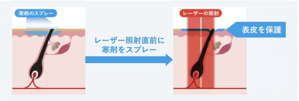 脱毛機械説明