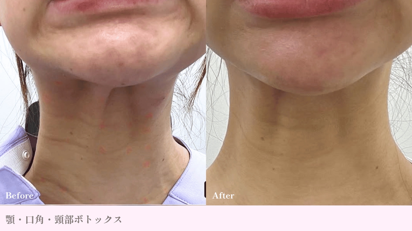 アラガン製ボトックス症例写真