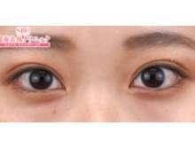 二重 二重整形の症例写真 二重 二重整形 11ページ目 湘南美容クリニック
