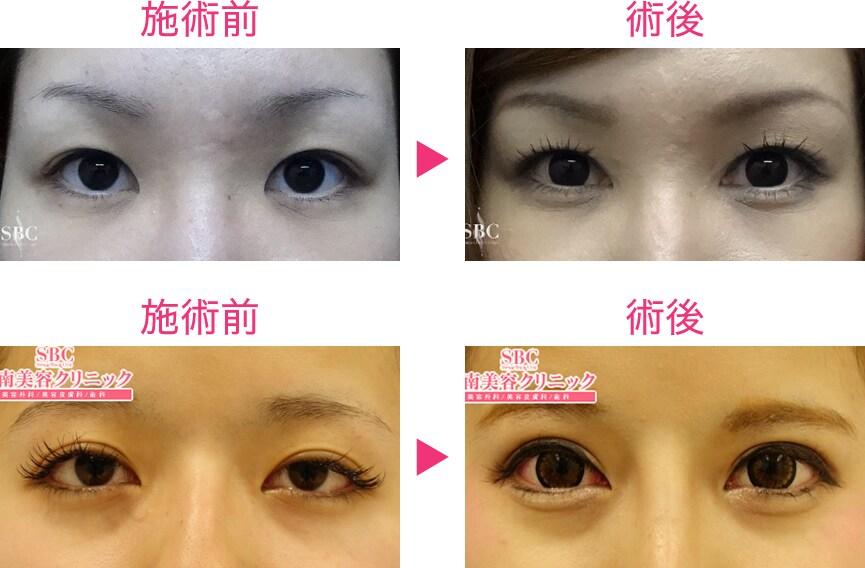 3年連続 Sbc Award最優秀賞受 二重 二重整形モニター募集 美容整形 美容外科の湘南美容クリニック 3年連続 Sbc Award最優秀賞受 二重 二重整形モニター募集 美容整形 美容外科の湘南美容クリニック
