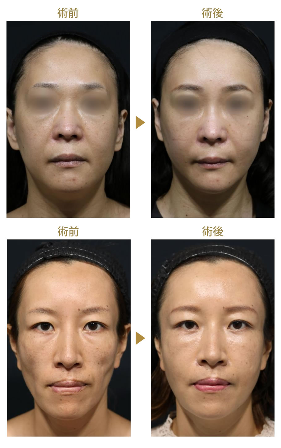 糸リフト クマ取り 脂肪移植 若返りモニター募集 美容整形 美容外科の湘南美容クリニック 糸リフト クマ取り 脂肪移植 若返りモニター募集 美容整形 美容外科の湘南美容クリニック