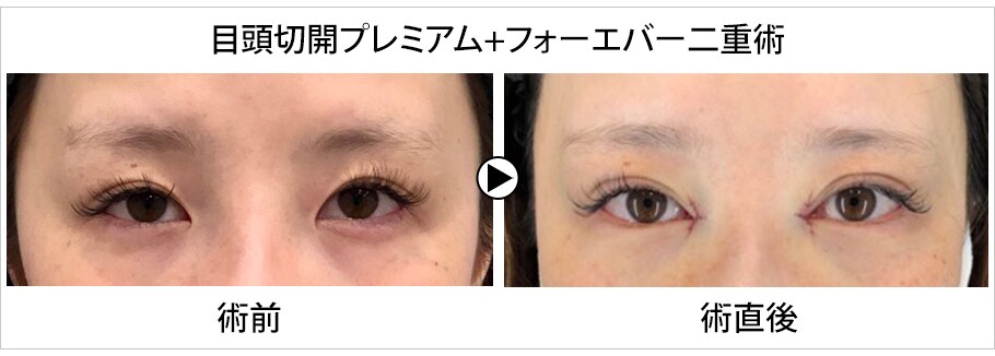 湘南公式目の切開エキスパートドクター 二重 二重整形モニター募集 美容整形 美容外科の湘南美容クリニック