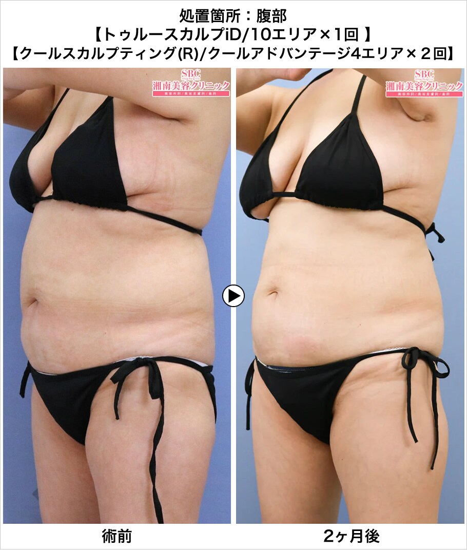 切らない痩身マシンクールスカルプティ 医療ダイエットモニター募集 美容整形 美容外科の湘南美容クリニック