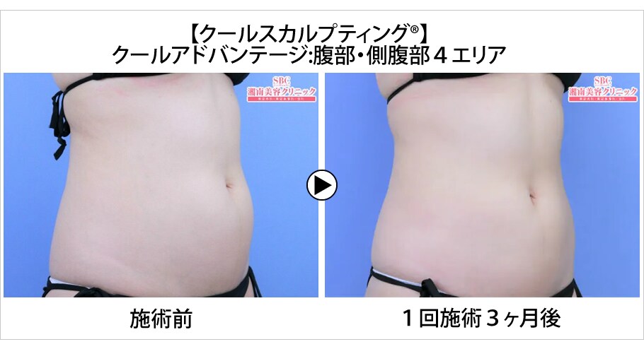 ミスユニバースが贈るオーダーメイド痩身 医療ダイエットモニター募集 美容整形 美容外科の湘南美容クリニック