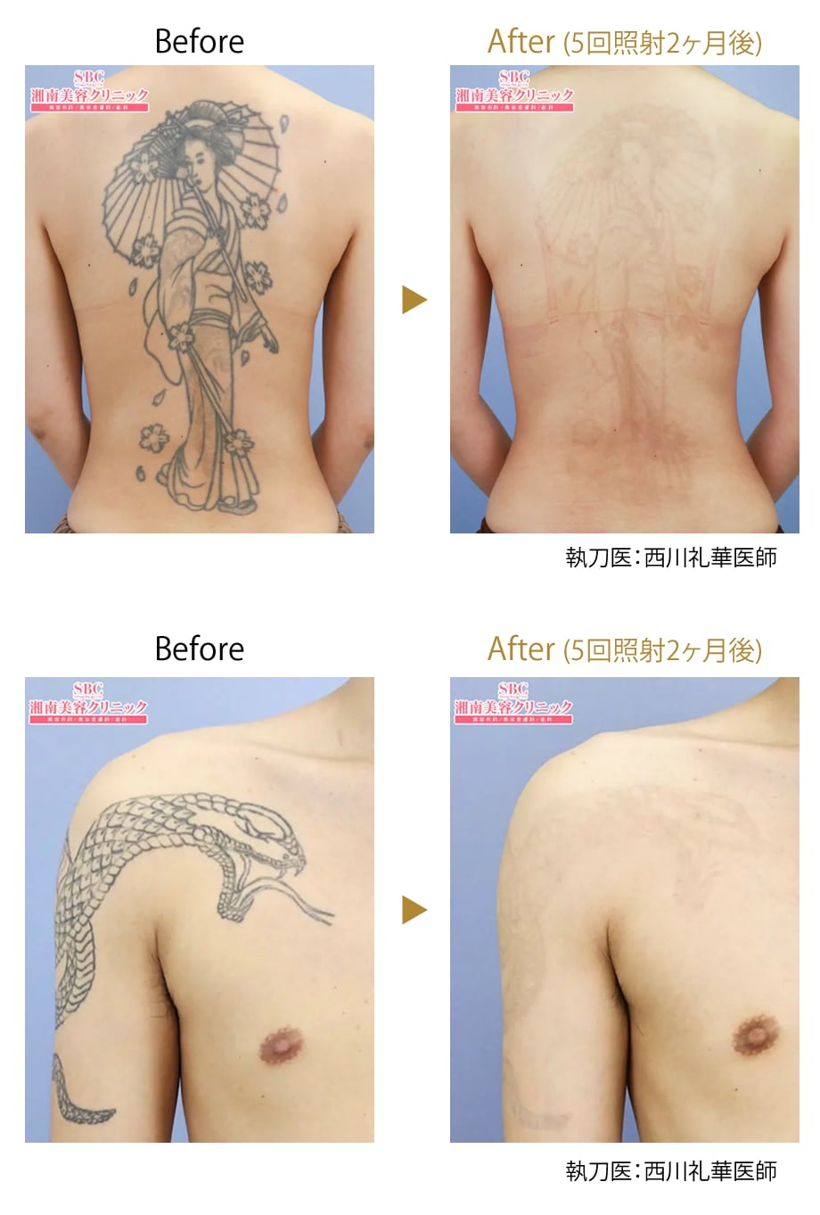 新宿本院 タトゥー除去 皮膚科全体統 タトゥー除去モニター募集 美容整形 美容外科の湘南美容クリニック